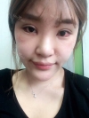 Ni (ptosis) + epi + lat — Korea cost, reviews & before-after | MISOODA