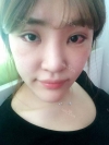 Ni (ptosis) + epi + lat — Korea cost, reviews & before-after | MISOODA