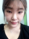 Ni (ptosis) + epi + lat — Korea cost, reviews & before-after | MISOODA