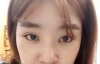 Ni (ptosis) + epi + lat — Korea cost, reviews & before-after | MISOODA