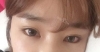 Ni (ptosis) + epi + lat — Korea cost, reviews & before-after | MISOODA