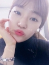 Ni (ptosis) + epi + lat — Korea cost, reviews & before-after | MISOODA