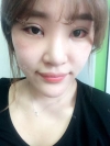 Ni (ptosis) + epi + lat — Korea cost, reviews & before-after | MISOODA