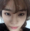 Ni (ptosis) + epi + lat — Korea cost, reviews & before-after | MISOODA