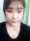 Ni (ptosis) + epi + lat — Korea cost, reviews & before-after | MISOODA