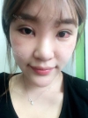 Ni (ptosis) + epi + lat — Korea cost, reviews & before-after | MISOODA