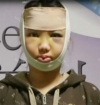She was suffering from crooked face! — Korea cost, reviews & before-after | MISOODA