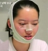 She was suffering from crooked face! — Korea cost, reviews & before-after | MISOODA