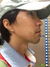 I want to be more gentle visually... — Korea cost, reviews & before-after | MISOODA