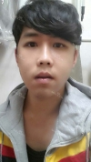 NANO Bimaxillary Diorthosis + Natural Mini V-line Reshaping+ Cheekbones Reduction + Eye reshaping — Korea cost, reviews & before-after | MISOODA