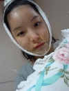 Cheekbone reduction + Natural Mini V-line — Korea cost, reviews & before-after | MISOODA