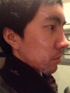 I want to be more gentle visually... — Korea cost, reviews & before-after | MISOODA