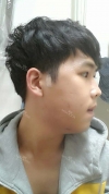 NANO Bimaxillary Diorthosis + Natural Mini V-line Reshaping+ Cheekbones Reduction + Eye reshaping — Korea cost, reviews & before-after | MISOODA