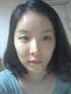 Cheekbone reduction + Natural Mini V-line — Korea cost, reviews & before-after | MISOODA