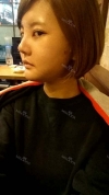 Cheekbone Reduction+ Mini V-line+ T.O.P Rrhinoplasty — Korea cost, reviews & before-after | MISOODA
