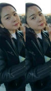 Ar + Zy + T / long hair + forehead / sil + epi + Rhino — Korea cost, reviews & before-after | MISOODA