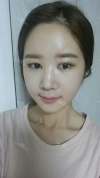 It's already been a year since I had the surgery~ — Korea cost, reviews & before-after | MISOODA