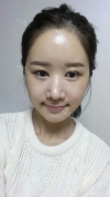 It's already been a year since I had the surgery~ — Korea cost, reviews & before-after | MISOODA