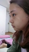 Ar + Zy + T / length extension — Korea cost, reviews & before-after | MISOODA
