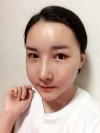 Ar + Zy + T + Pa (sil) + Rhino + weir + Ni (re) ptosis + Lat — Korea cost, reviews & before-after | MISOODA