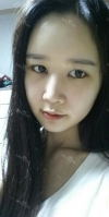 It's already been a year since I had the surgery~ — Korea cost, reviews & before-after | MISOODA