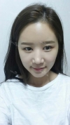 It's already been a year since I had the surgery~ — Korea cost, reviews & before-after | MISOODA