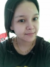 fg (forehead, zygoma), ni (fat), rhino (using donated cartilage and if more is needed ear cartilage) — Korea cost, reviews & before-after | MISOODA