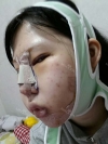 Ar + Zy (PPC) + T / adv + NI / ptosis + Rhino / lo #Free — Korea cost, reviews & before-after | MISOODA