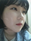 Ar + Zy (PPC) + T / adv + NI / ptosis + Rhino / lo #Free — Korea cost, reviews & before-after | MISOODA