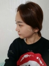 Ar + Zy + T / long hair + forehead / sil + epi + Rhino — Korea cost, reviews & before-after | MISOODA