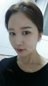 It's already been a year since I had the surgery~ — Korea cost, reviews & before-after | MISOODA