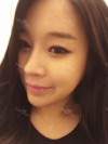 ar zy t (adv heading), fg (forehead), rhino (lo), pa (sil), aky ni (ptosis re), lat — Korea cost, reviews & before-after | MISOODA