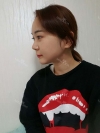 Ar + Zy + T / long hair + forehead / sil + epi + Rhino — Korea cost, reviews & before-after | MISOODA