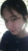 It's already been a year since I had the surgery~ — Korea cost, reviews & before-after | MISOODA