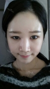 It's already been a year since I had the surgery~ — Korea cost, reviews & before-after | MISOODA