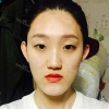 (Two-jaw) + Ar + T (red) + Transparent correction + F.g (Forehead) + (Positive) Ni (ptosis) + Epi — Korea cost, reviews & before-after | MISOODA