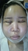 It's already been a year since I had the surgery~ — Korea cost, reviews & before-after | MISOODA