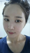 It's already been a year since I had the surgery~ — Korea cost, reviews & before-after | MISOODA