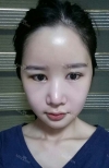 It's already been a year since I had the surgery~ — Korea cost, reviews & before-after | MISOODA
