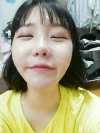Ar + Zy (PPC) + T / adv + NI / ptosis + Rhino / lo #Free — Korea cost, reviews & before-after | MISOODA