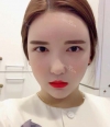 Ar + Zy + T + LP (jaw line) + thread lifting + (tack) Rhino (re) — Korea cost, reviews & before-after | MISOODA