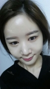 It's already been a year since I had the surgery~ — Korea cost, reviews & before-after | MISOODA