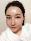 Ar + Zy + T + Pa (sil) + Rhino + weir + Ni (re) ptosis + Lat — Korea cost, reviews & before-after | MISOODA