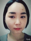 Ar + Zy + T / long hair + forehead / sil + epi + Rhino — Korea cost, reviews & before-after | MISOODA