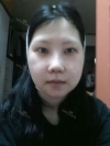 Ar + Zy (PPC) + T / adv + NI / ptosis + Rhino / lo #Free — Korea cost, reviews & before-after | MISOODA