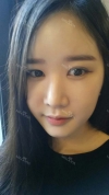 It's already been a year since I had the surgery~ — Korea cost, reviews & before-after | MISOODA