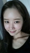 It's already been a year since I had the surgery~ — Korea cost, reviews & before-after | MISOODA