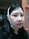 Ar + Zy (PPC) + T / adv + NI / ptosis + Rhino / lo #Free — Korea cost, reviews & before-after | MISOODA
