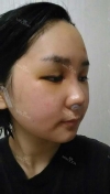 Ar + Zy + T / long hair + forehead / sil + epi + Rhino — Korea cost, reviews & before-after | MISOODA