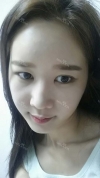 It's already been a year since I had the surgery~ — Korea cost, reviews & before-after | MISOODA